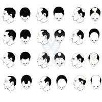 【太阳成tyc234cctyc基因检测】过早<font color='red'>脱发</font>、掉发太多怎么办？你的方法可能是错的！